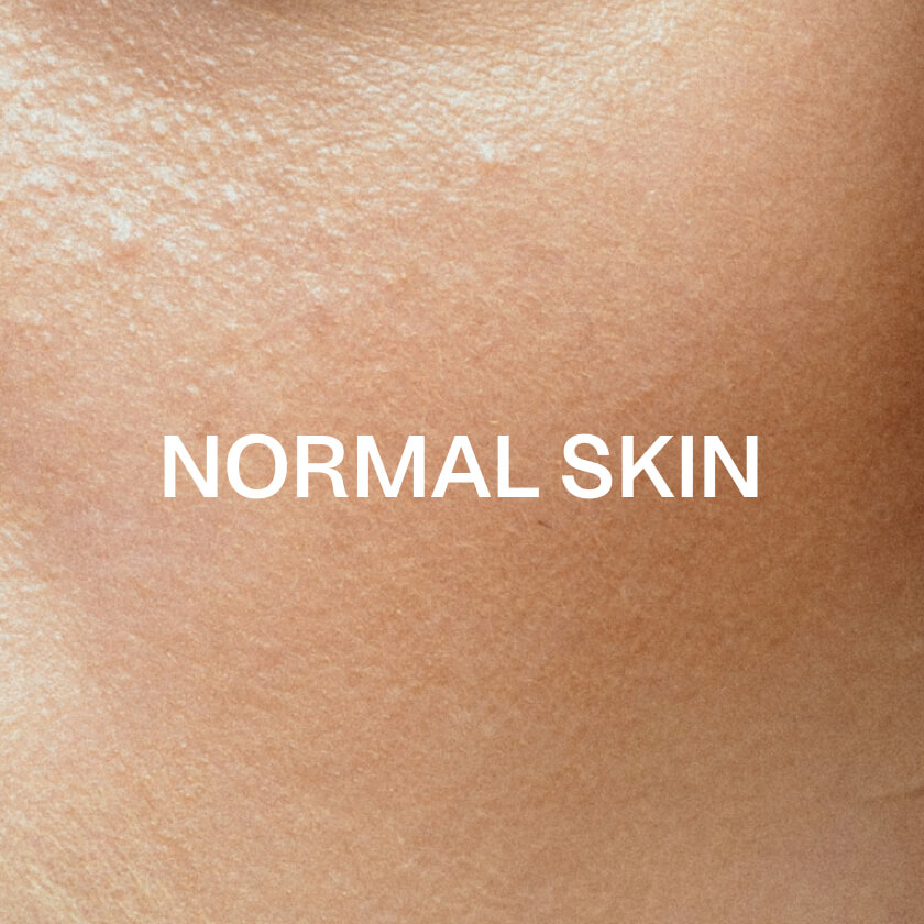 Normale huid