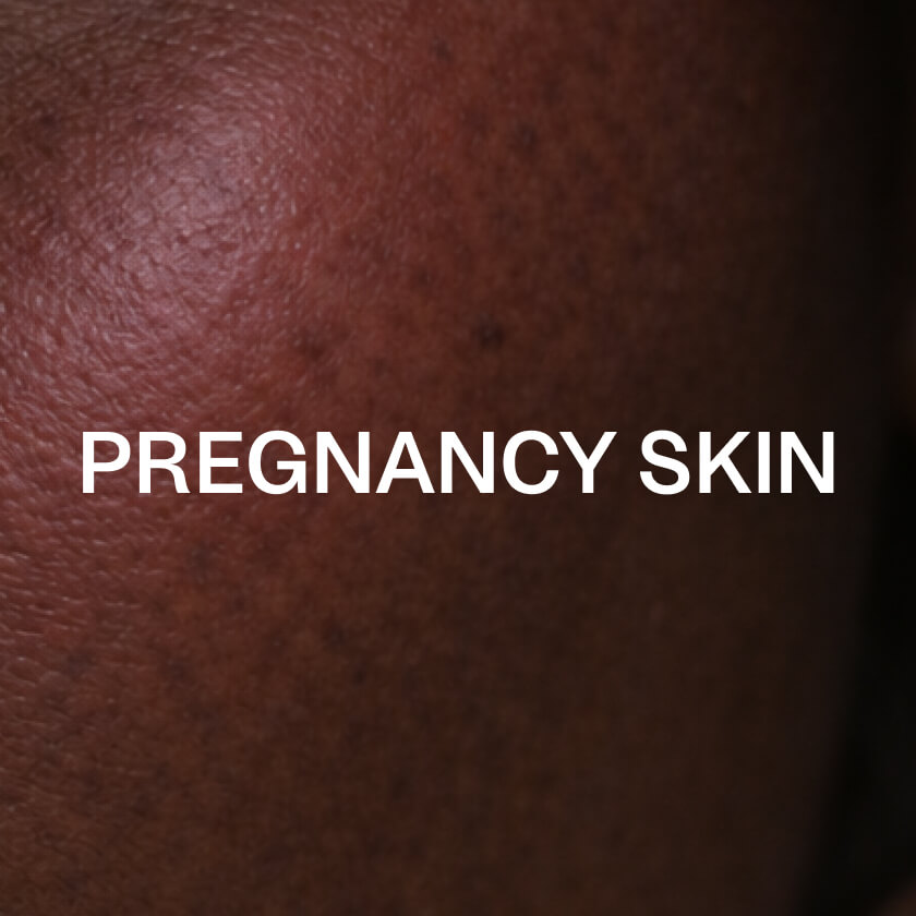 Huid tijdens de zwangerschap