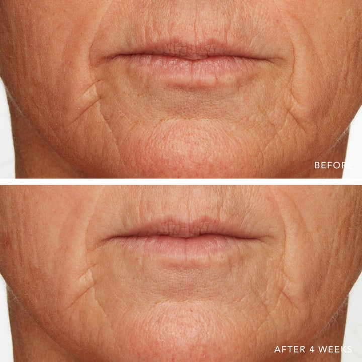 Caviar Lime Acid Peel
