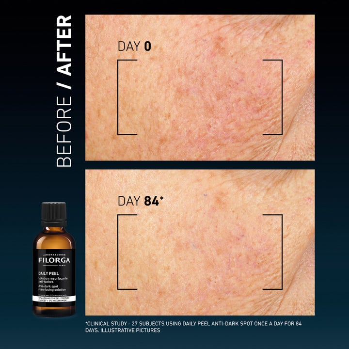 Clinical Home Peel Dark Spot