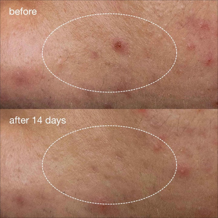 Deep Acne Liquid Patch Duo