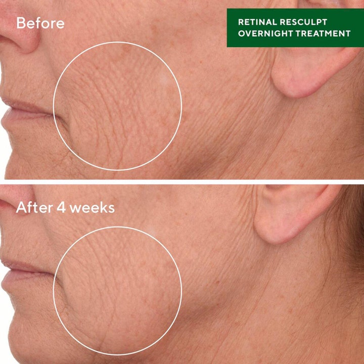 Retinal ReSculpt Treatment